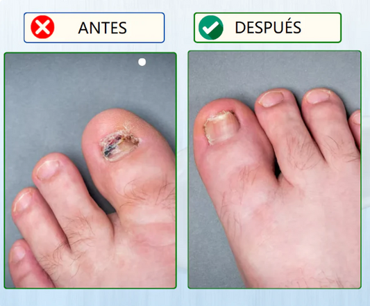 2️⃣🇽1️⃣ Parches para uña - Anti hongo🌿👣