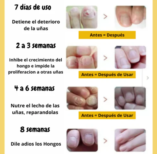 2️⃣🇽1️⃣ Parches para uña - Anti hongo🌿👣